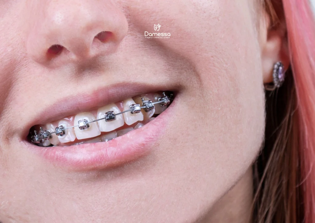 Self Ligating Braces