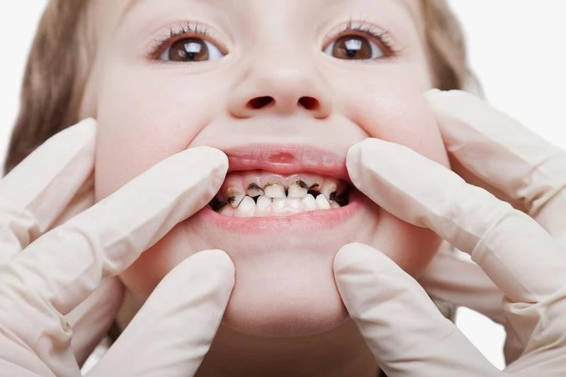 bahaya karies gigi pada anak