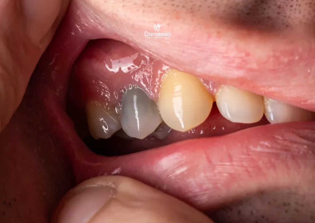 Cara menghilangkan gigi hitam di tengah