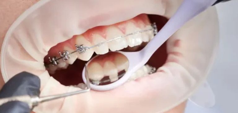 Harga Behel Damon Self Ligating