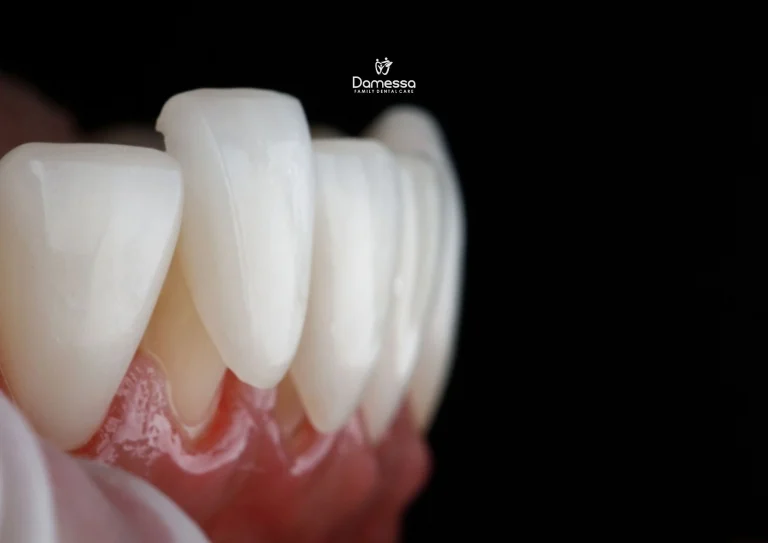 Biaya pemasangan crown gigi