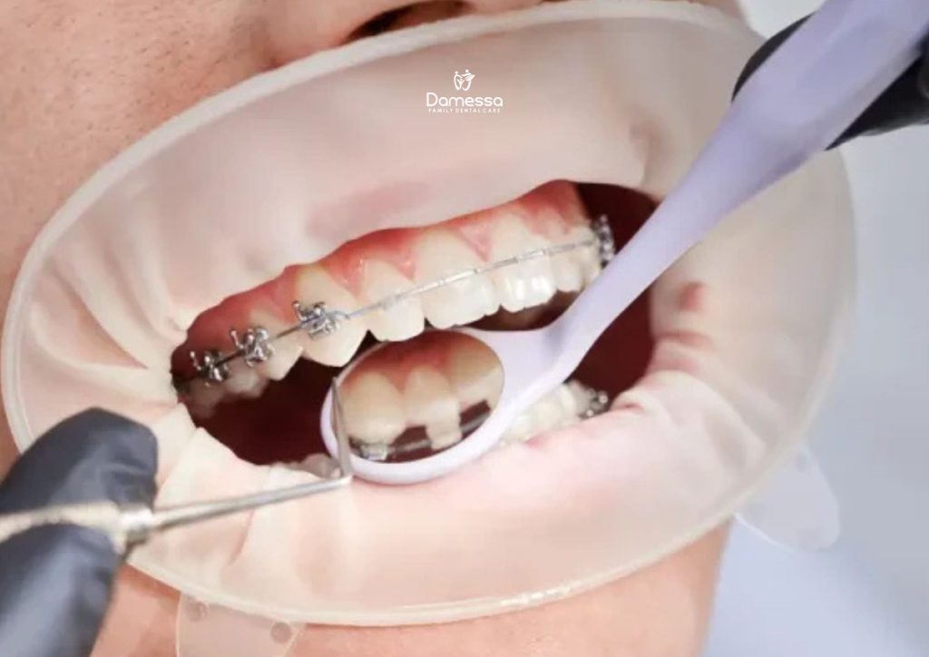 Harga Behel Damon Self Ligating