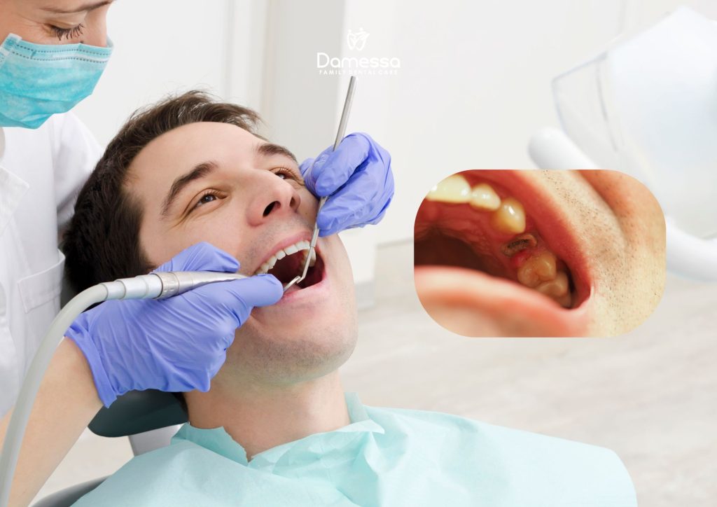 biaya cabut sisa akar gigi 1