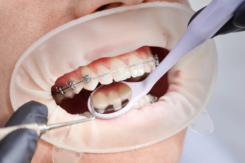 ceramic braces