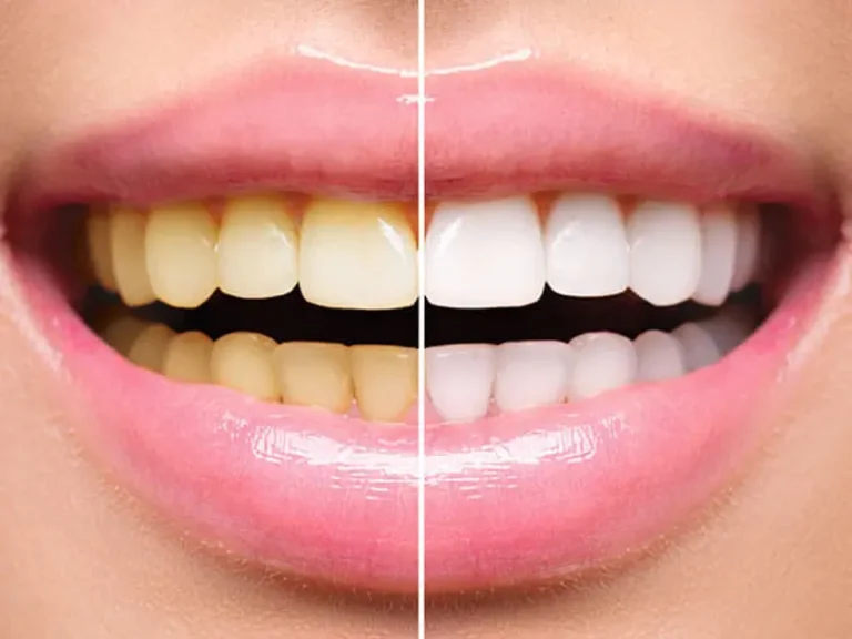 bleaching gigi