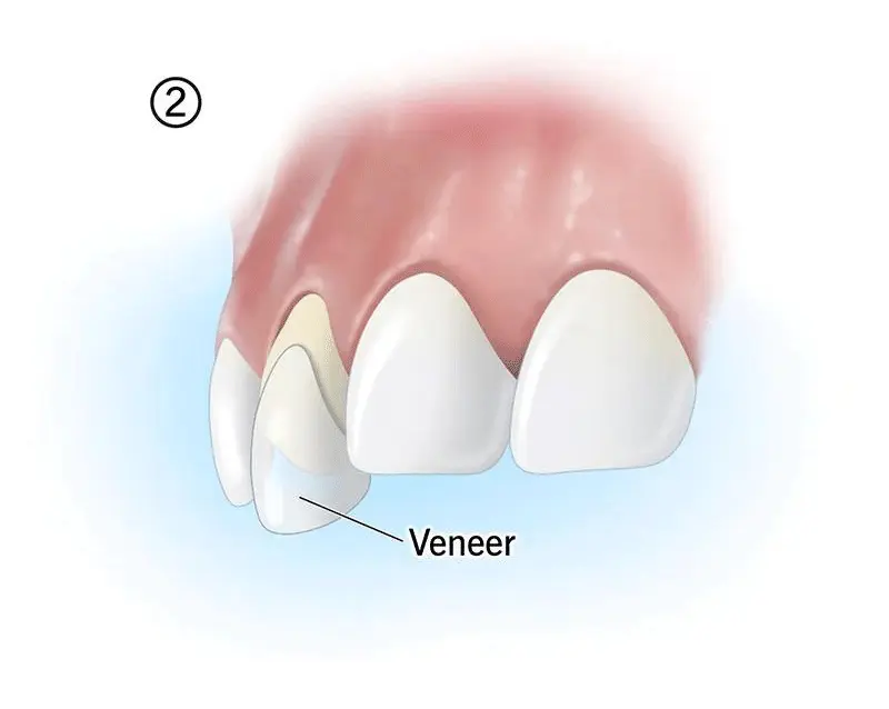 veneer 2