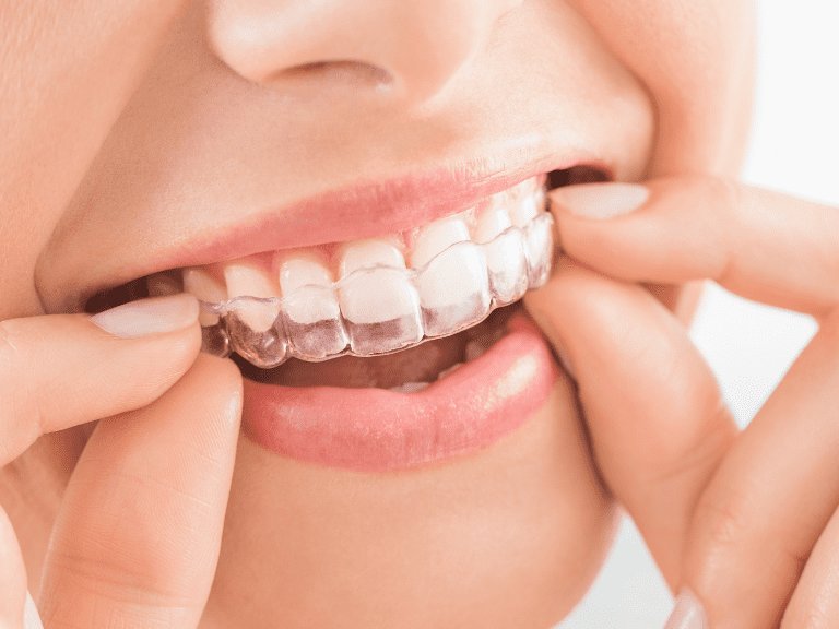 orang memasang aligner gigi