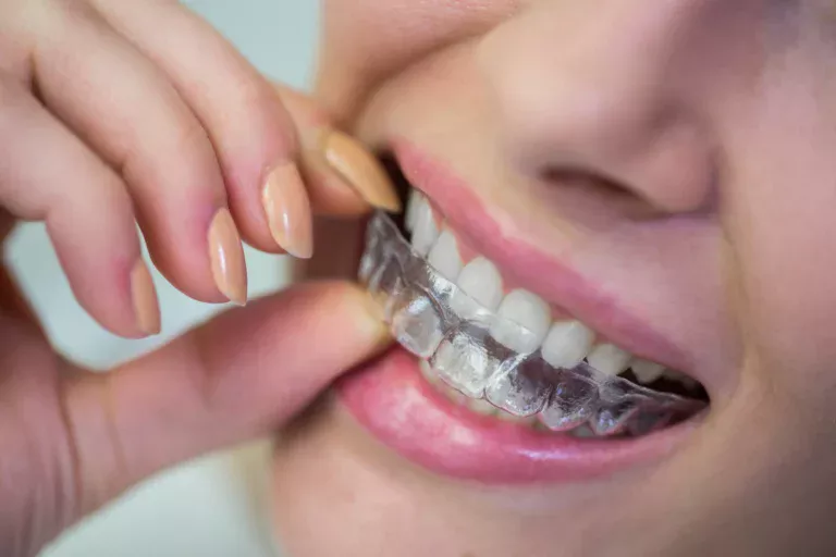 pasang aligner gigi di cibubur