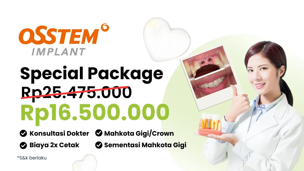 Implant Gigi Osstem