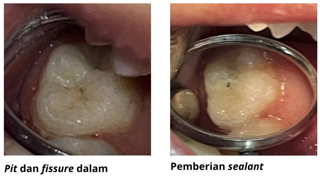 Pit and Fissure dalam