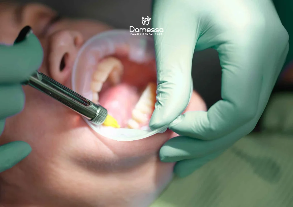 harga scaling gigi di puskesmas