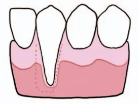Animasi gusi turun Patel Nixon dan Chan 2011 Animasi gusi turun