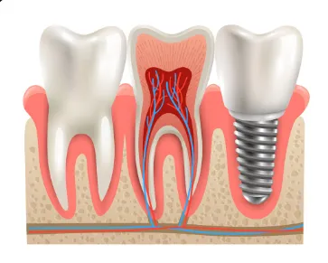 Berapa Lama Implan Gigi Bisa Bertahan