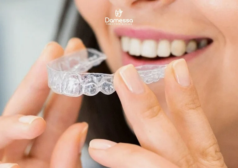 Aligner atau Behel