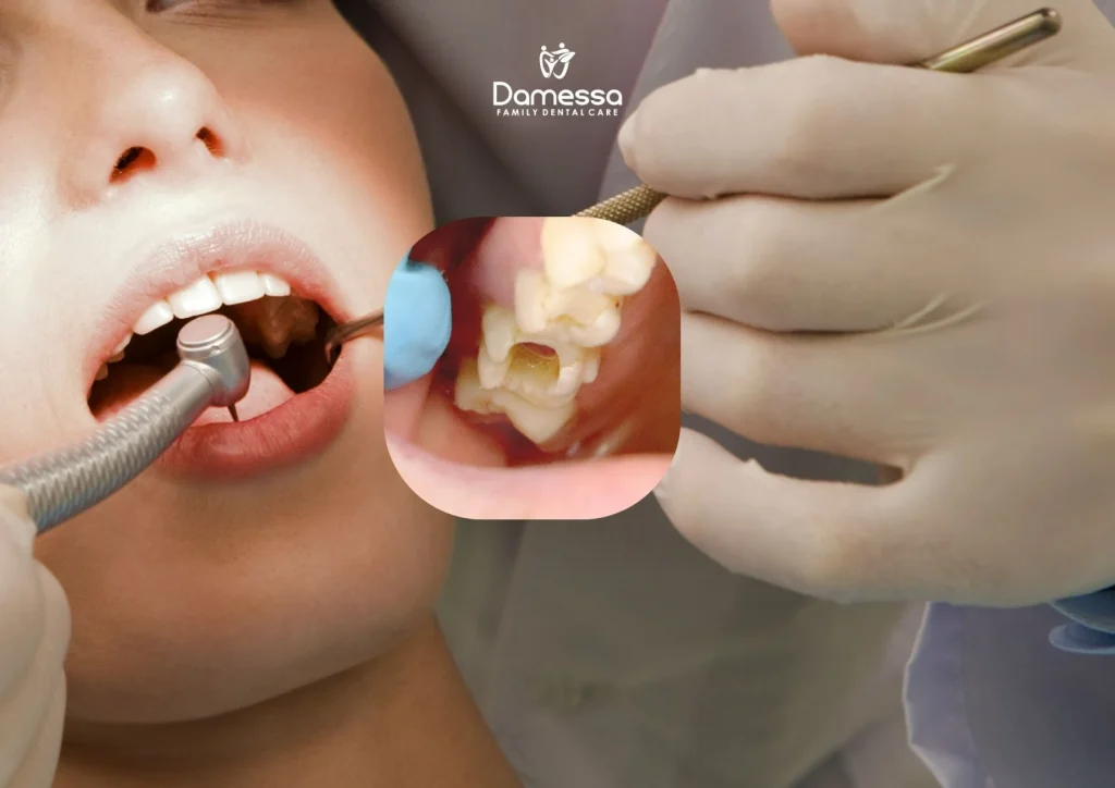 Tambal Gigi atau Cabut Gigi