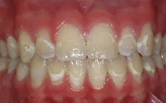 Bercak putih pada gigi depan sebagai tanda awal gigi berlubang