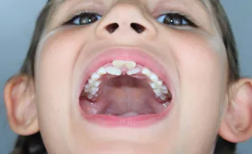 Gigi Anak Tumbuh Dua Baris