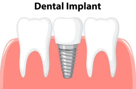 Pemulihan Implan Gigi