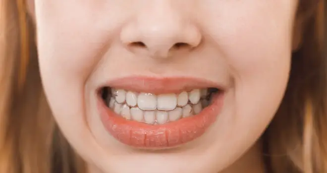 Gigi Tengah Tidak Simetris Gigi Tengah Tidak Simetris