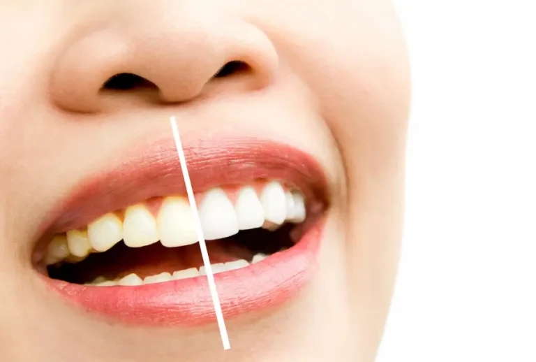 Veneer Gigi