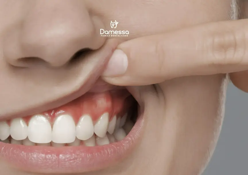 obat nyeri gigi antalgin