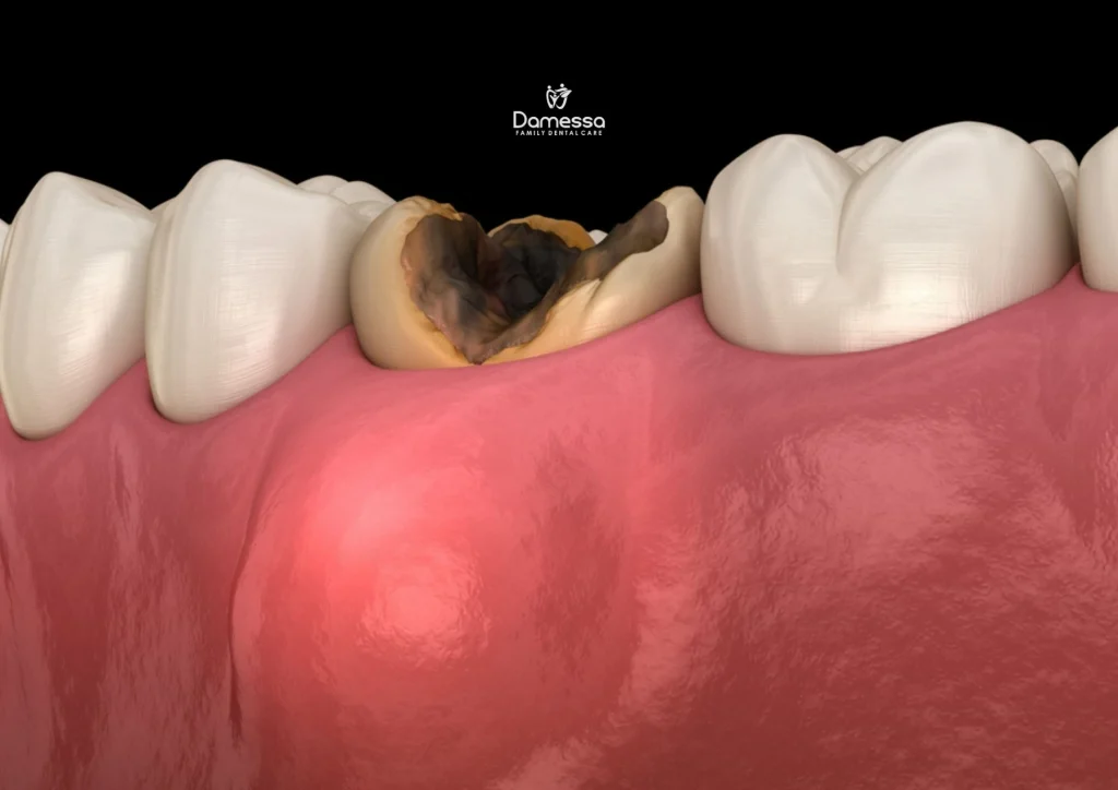 Gigi Berlubang Bisa Sembuh Sendiri