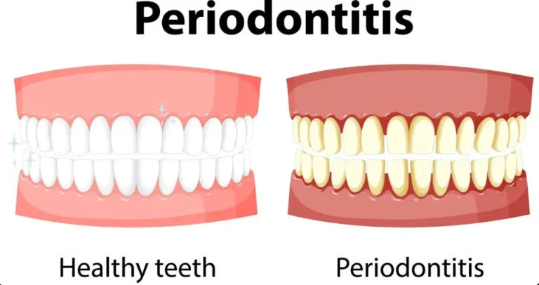 Periodontitis Gigi Goyang