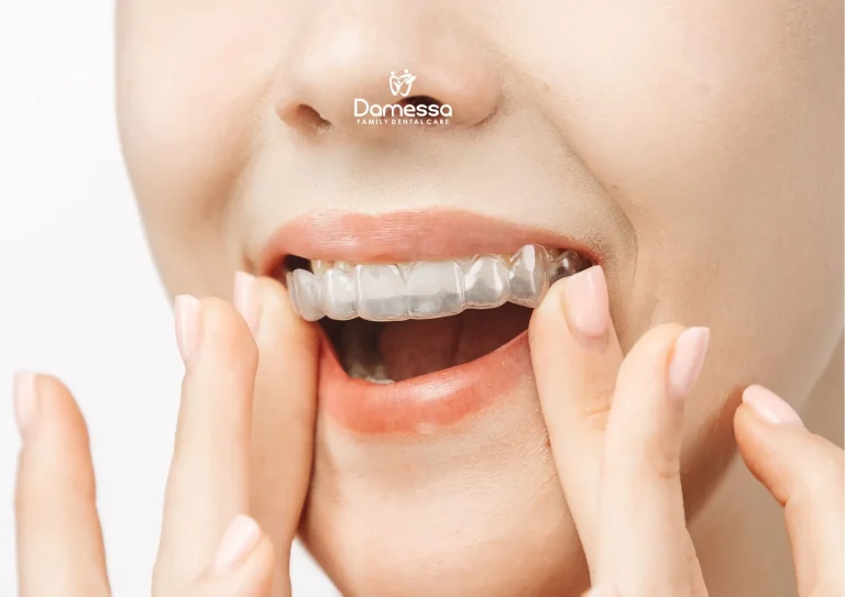 Invisalign, Pilihan Merapikan Gigi Tanpa Kawat yang Perlu Diketahui